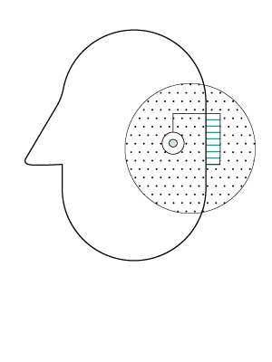 Implantable hearing devices in clinical practice. Systematic review and consensus statements