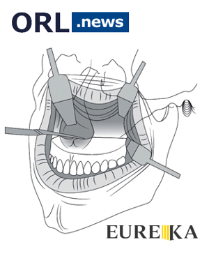 OSTEOTOMIA TIPO LE FORT 1