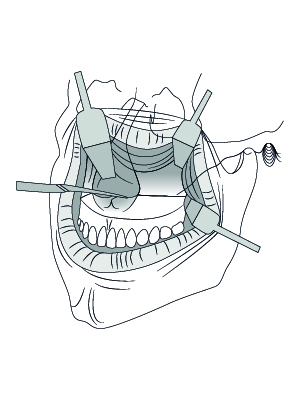 Osteotomia tipo Le Fort 1