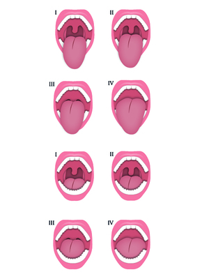 Classificazione di Mallampati e di Mallampati modificata o Friedman tongue position