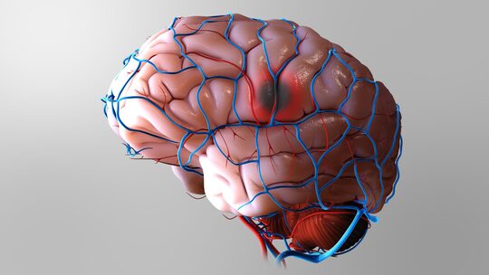 Sordità improvvisa e vertigini come prodromi della sindrome AICA