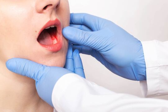 Per la prima volta in Italia la chirurgia robotica transorale alla prova sui calcoli salivari