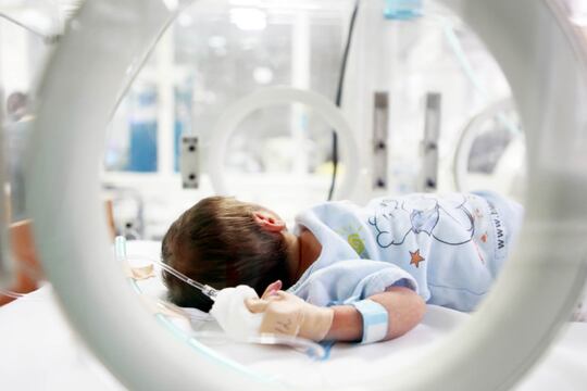 Metaplasia squamosa dell’epitelio tracheale nel neonato intubato e nel bambino con tracheostomia