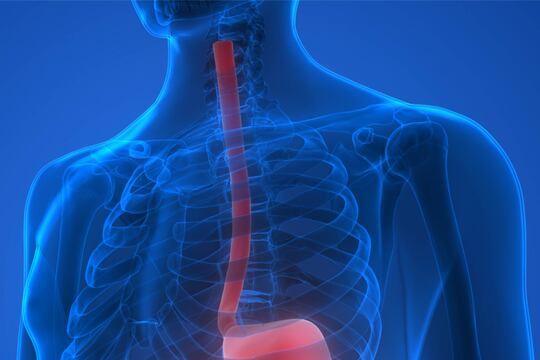 Esofago di Barrett: caratteristiche, diagnosi e trattamenti