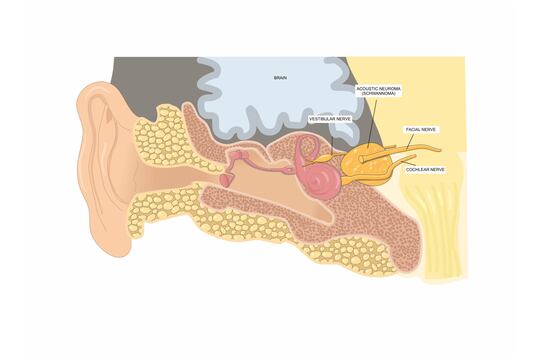 Il management del neurinoma dell’VIII nervo cranico in Italia